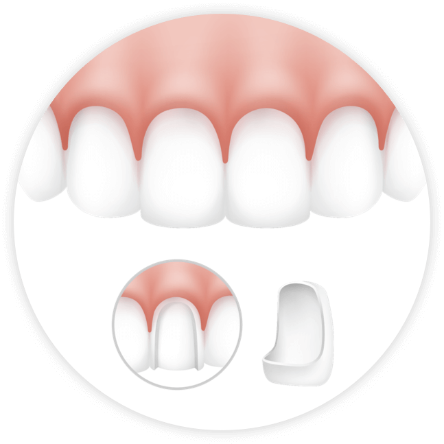Schematische Darstellung eines Veneers