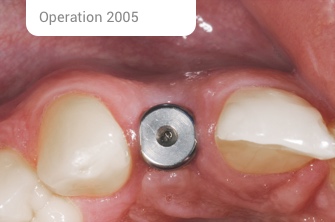 Kollegen Implantat Op 2005 2